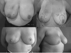 Secuela de tipo 1 en una paciente con mamas hipertróficas tratada con reducción mamaria bilateral.