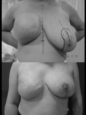 Segundo tiempo de reconstrucción mamaria diferida mediante el método expansión-prótesis. Resultado después del cambio del expansor por una prótesis anatómica y mamoplastia de reducción de la mama izquierda para conseguir su simetría.