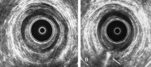 Fístula interesfinteriana posterior. A: ecografía endoanal inicial sin hallazgos. B: tras inyección de H2O2 se observa un tracto fistuloso en la línea media posterior (flecha) limitada por el esfínter anal externo.