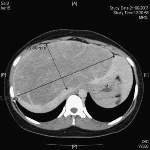 Tumor hepático que mide 22×10cm de eje transversal.