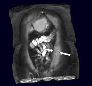 Reconstrucción coronal de tomografía computarizada abdominal donde se muestra una masa en la pared abdominal anterior.