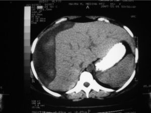 Tomografía que muestra hematoma subcapsular hepático.