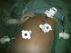 Posición de los trócares.