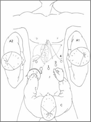 Posición del paciente, ayudantes y trócares (numerados de 1 a 4), con nuestra técnica original asistida con la mano.