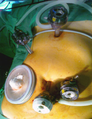 Imagen intraoperatoria de la cirugía laparoscópica asistida con la mano, original de nuestra unidad.