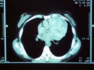 Tomografía computarizada de tórax que muestra un tumor lobulado en el mediastino anterior-izquierdo en amplio contacto con el pericardio.