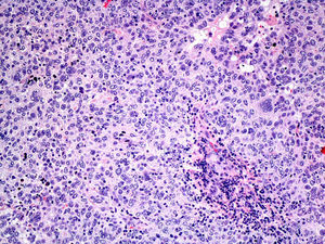 Vista microscópica del tumor con tinción de hematoxilina-eosina, ×10 aumentos. Se evidencian células tumorales con núcleos vesiculosos, de nucléolos prominentes, binucleadas o multinucleadas. Mitosis atípicas.