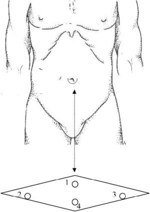 Colocación de los trócares en el espacio periumbilical. 1: trocar de 5mm para cámara de 30°. 2: trocar de 5mm para coagulación monopolar (gancho), disector, aplicador de clips y tijera articulada. 3: trocar de 5mm para pinza tractora articulada. 4: trocar opcional para tracción del fundus vesicular.