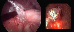 Apertura transgástrica con balón de dilatación (vista laparoscópica y endoscópica).