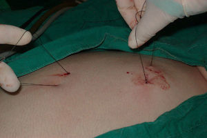 Vista externa de las suturas en forma de riendas que se introducen a la cavidad abdominal por vía percutánea mediante agujas rectas y se utilizan para traccionar la vesícula biliar.