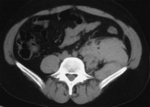 Tomografía computarizada que muestra un voluminoso hematoma del iliopsoas izquierdo.