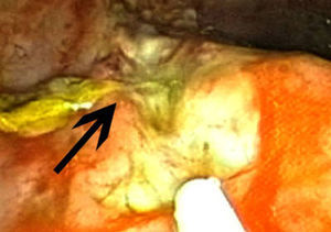 Úlcera de íleon con fibrina (flecha).