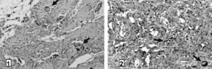 Técnica de inmunohistoquímica mediante el uso del anticuerpo monoclonal anti-CD (cluster of differentiation 