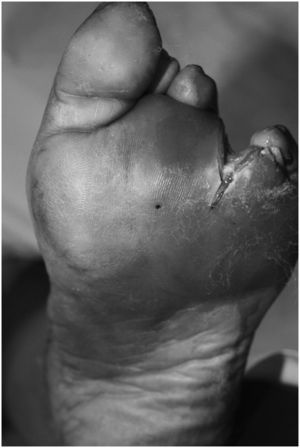Infección profunda en un pie diabético tras amputación del cuarto dedo (Wagner 3, Universidad de Texas 3D). Llama la atención la supuración de la herida y los signos de infección (eritema y tumefacción) en la cara plantar del pie.