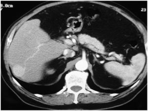 Hepatocarcinoma de 3cm entre los segmentos VI y VII, visible en fase arterial.