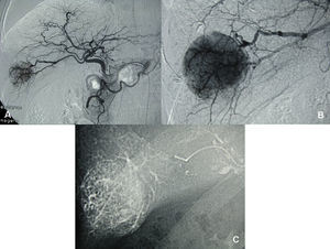 (A, B y C). Arteriografía del tumor y quimioembolización selectiva con oclusión de las ramas arteriales segmentarias del VI y VII.