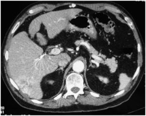 TC de control a las 4 semanas posquimioembolización, donde se observa la necrosis del tumor y la zona con isquemia arterial (segmentos VI y VII).
