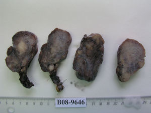 Varios cortes sagitales que muestran una tumoración sólida, compacta, compuesta por fascículos entrelazados.