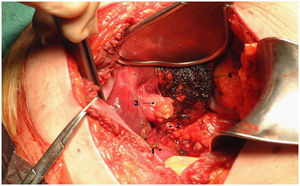 1) Vía biliar principal. 2) Ligadura del muñón del conducto cístico. 3) Ligamento redondo seccionado y ligado. 4) Lecho vesicular tras la colecistectomía.