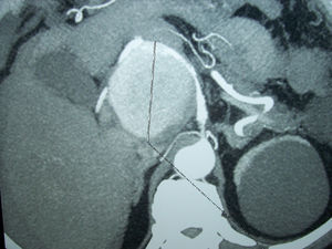 Tomografía computarizada abdominal con contraste intravenoso: aneurisma en la arteria hepática común de 7cm, parcialmente trombosado y roto, con hemoperitoneo importante.