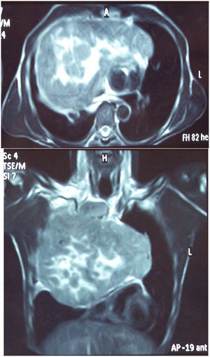 Resonancia magnética de tórax: masa gigante en mediastino anterosuperior. La vena cava superior está englobada en el tumor, el cual tiene efecto masa en la silueta cardíaca.
