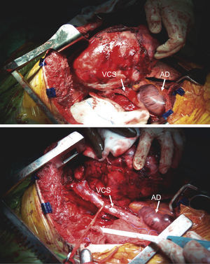Intervención quirúrgica. Disección de la vena cava superior (VCS) tras apertura del pericardio. La escisión quirúrgica completa es la clave del tratamiento de las lesiones que están totalmente encapsuladas (AD: aurícula derecha).