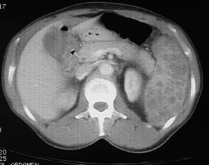 Tomografía computarizada que muestra lesiones hipodensas esplénicas y hemoperitoneo.