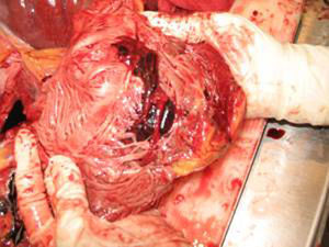 Material tromboembólico en la cámara ventricular derecha, adherido a la válvula tricúspide.