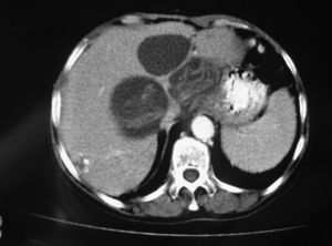 Tomografía computarizada abdominal.