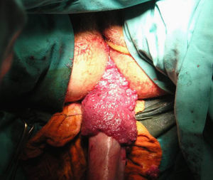 Eversión rectal para comprobar la extensión distal del tumor, que se sitúa a 1cm de la línea pectínea.