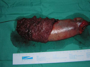 Pieza quirúrgica en la que se observa tumoración rectal de aspecto velloso que se extiende hasta 1cm de la línea pectínea (extremo distal marcado con seda), con una longitud aproximada de unos 10cm.