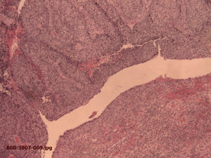 Carcinoma basaloide sobre fístula. Detalle histológico (H-E, ×40).