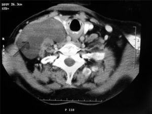 Tomografía computarizada del cuello que muestra la imagen de un linfangioma quístico (flecha).