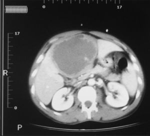 Absceso en el lóbulo hepático izquierdo, en donde se pueden apreciar las dimensiones del absceso y la radiopacidad del drenaje percutáneo.