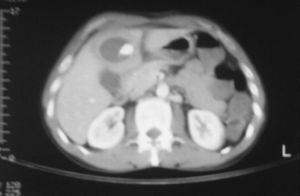 Disminución importante del absceso tras cirugía con drenaje en la cavidad.