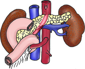 Dibujo esquemático del tratamiento.