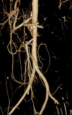 Reconstrucción vascular poscirugía mediante TAC.
