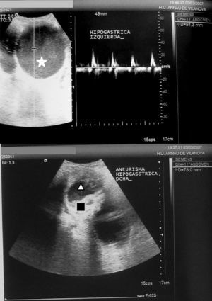 Eco-Doppler abdominal. Aneurisma de la arteria ilíaca interna izquierda (estrella) y de la arteria ilíaca interna derecha (triángulo) con imagen hiperecogénica intramural (cuadrado).