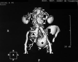 Tomografía axial computarizada abdominal. Obsérvese la reconstrucción en 3D con ambos aneurismas de las arterias ilíacas internas, marcados con una estrella (izquierda) y con un triángulo (derecha).