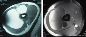 Tomografía computarizada y resonancia magnética con imágenes de la masa bilobulada, homogénea, intermuscular, en contacto con el húmero, compatible con lipoma.