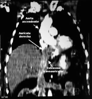 Imagen de la tomografía computarizada en la que se observa la afectación del eje cavoauricular y de ambas venas renales.