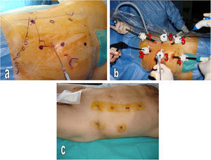 Puntos de inserción de los trocares laparoscópicos. 1: óptica; 2 y 3: cirujano; 4: port de ayuda; 5: aspirador; 6: cirujano/ayudante/cámara (fig. a y b). Heridas quirúrgicas de los ports laparoscópicos (fig. c).