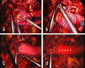 Hemisutura anterior (a); hemisutura posterior (b); anudado intracorpóreo final (c); despinzamiento con estanqueidad de la anastomosis aórtica (d).