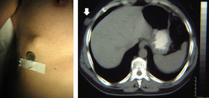 Fotografía de la tumoración y corte de la TAC (tumoración señalada con una flecha).