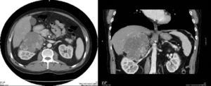 Tomografía computarizada abdominal: carcinoma suprarrenal derecho.