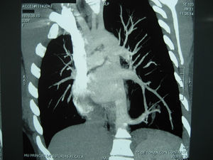 Tomografía axial computarizada torácica. Corte coronal. Secuestro pulmonar intralobular.