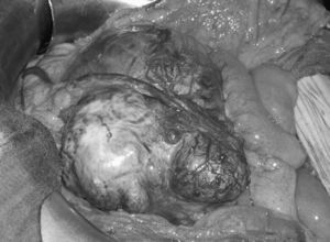 Imagen del campo quirúrgico. Masa retroperitoneal que desplaza el intestino lateralmente.