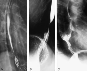 A: hernia de hiato por deslizamiento. B: estenosis corta y de bordes regulares. C: estenosis esofágica de bordes irregulares sospechosa de malignidad.