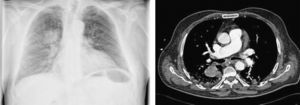 Radiografía de tórax: se observa una masa en el lóbulo superior derecho (LSD), que posteriormente se confirma en la tomografía computarizada de tórax, y que resulta indicativa de neoplasia primaria pulmonar.
