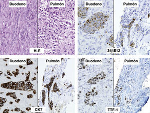 Hematoxilina-eosina (duodeno): mucosa duodenal ulcerada e infiltrada por células tumorales que crecen en nidos compactos, rodeados por grave reacción desmoplásica e inflamación crónica y aguda (20×). Estudio inmunohistoquímico (duodeno): la lesión tumoral expresa 34ßE12, citoqueratina 7 y TTF-1. Estos hallazgos inmunohistoquímicos, junto con los histológicos, indican que se trata en primer lugar de un tumor de origen pulmonar. Biopsia transbronquial correspondiente a lesión tumoral pulmonar: escasa representación de células tumorales, artefactadas por la toma de biopsias, con morfología similar a la observada en la lesión duodenal e idéntica expresión de marcadores inmunohistoquímicos.